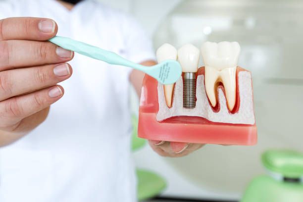 9 Alternative to Dental Implants: New Update