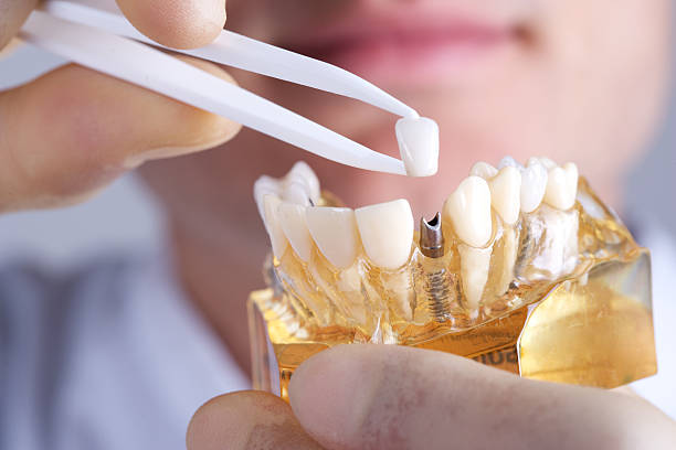 9 Alternative to Dental Implants: New Update