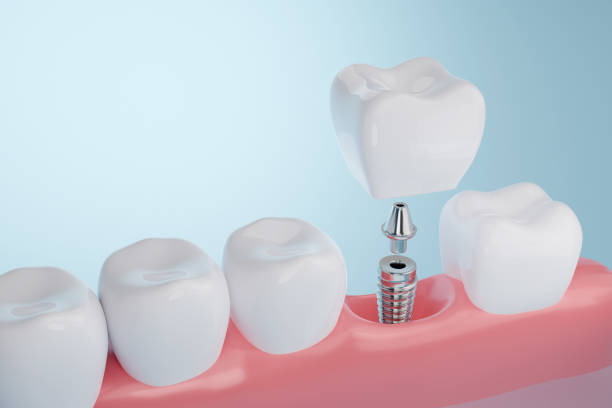 Dental Implants Pros And Cons: Everything You Need To Know