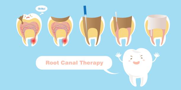 How Bad Is A Root Canal: All About Root Canal