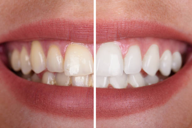 How To Remove Yellow Stains On Teeth: 9 Effective Tips